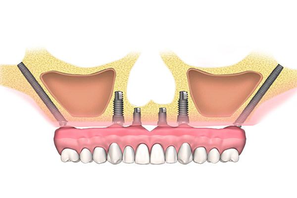 Zigomático - Implante Dental Málaga